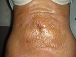 2 days post procedure
